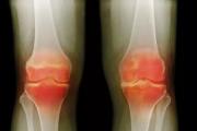 干细胞疗法在骨关节炎的临床研究项目多达七项，骨关节炎